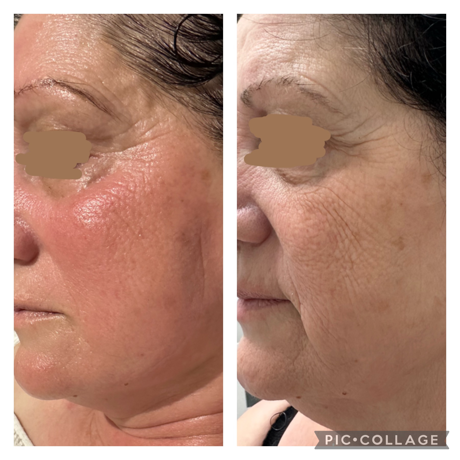 לפני ואחרי - קמטים