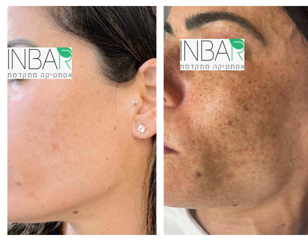 לפני ואחרי - פיגמנטציה