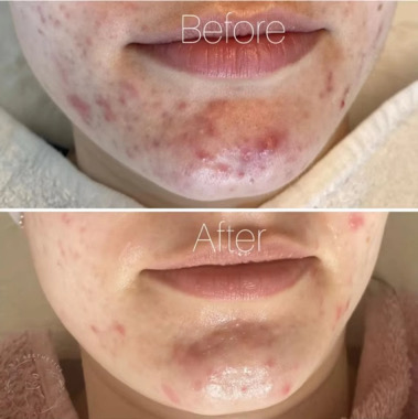 לפני ואחרי - אקנה