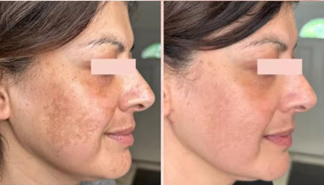 לפני ואחרי - פיגמנטציה